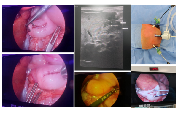 Laparoscopic Pyloromyotomy in a 3 Weeks Old Infant