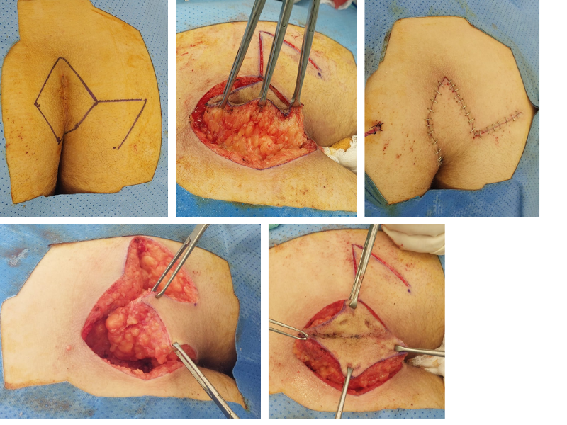 Limberg Flap Repair of Recurrent Pilonidal Sinuses