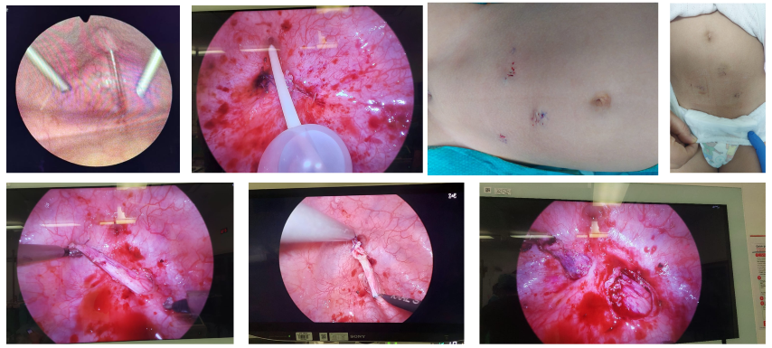 Vesicoscopic Repair of Right Ureterovesical Junction Obstruction