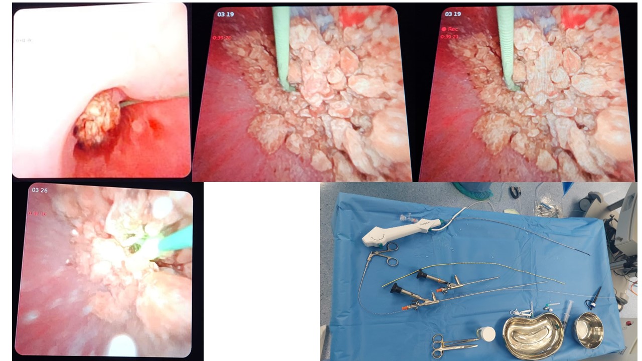 RIRS - Ureteroscopic Laser Lithotripsy for Right Renal Calculi in 8yr Old Girl