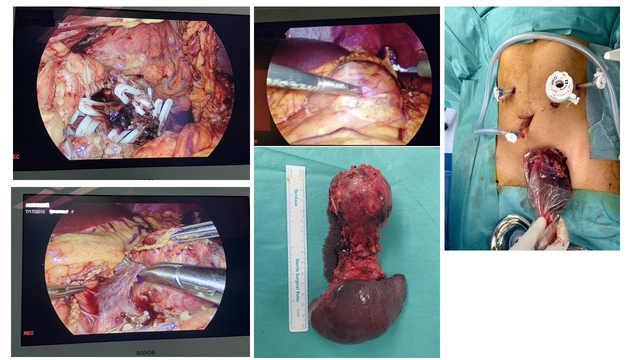 Laparoscopic Subtotal Pancreatectomy and Splenectomy for Large Tumor in 13yr Old