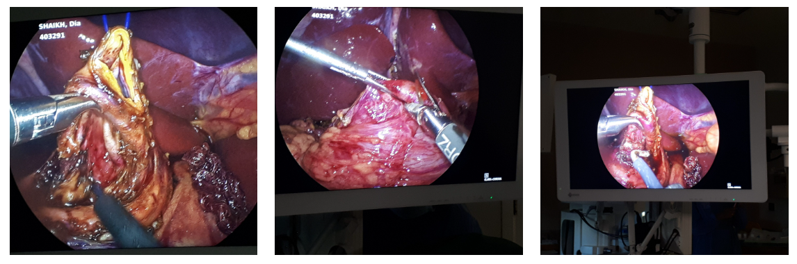Successful Laparoscopic Excision of Type 1c Choledochal Cyst