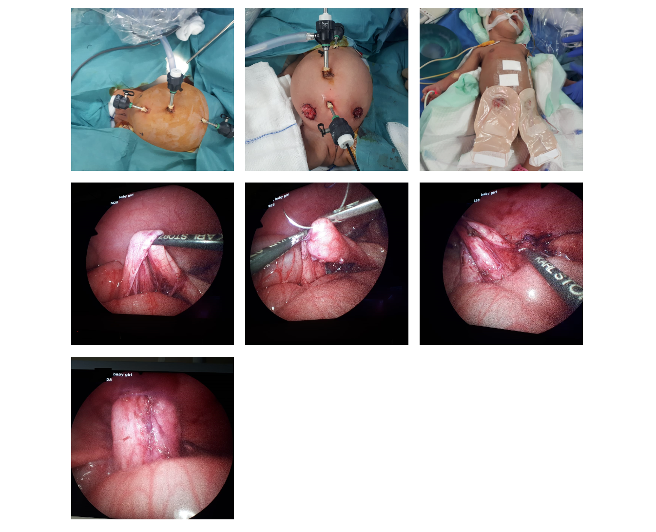 Laparoscopic Ureterostomy and Cystoscopic Deroofing of Cecoureterocele in 18 Days Old Girl