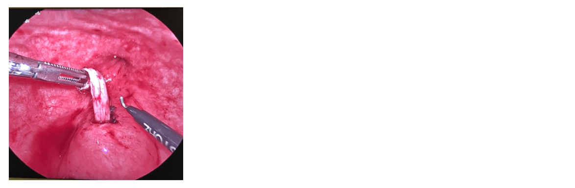 Pneumovesicoscopic Bilateral Ureteric Reimplantation in 4yr Old Child