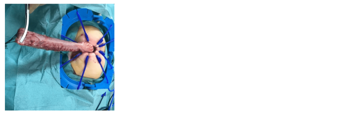 Testicular and Intestinal Salvage in 2kg Neonate with Strangulated Inguinal Hernia