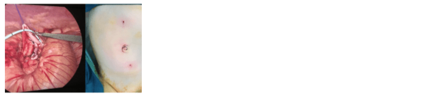 Laparoscopic Removal of Hemorrhagic Cyst from 40 Days Old Girl