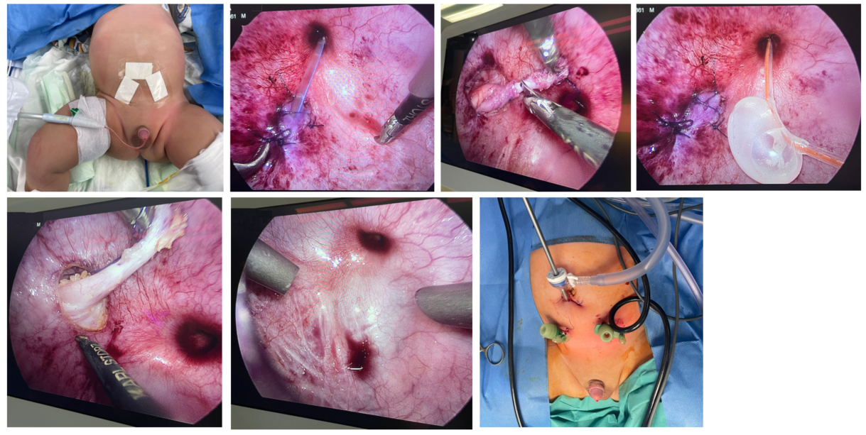 Pneumovesicoscopic Bilateral Ureteric Reimplantation for Bilateral VUR and Nephropathy