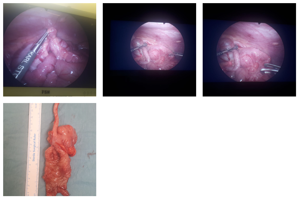 Ileal Duplication Cyst Causing Intussusception in 2yr Old Girl