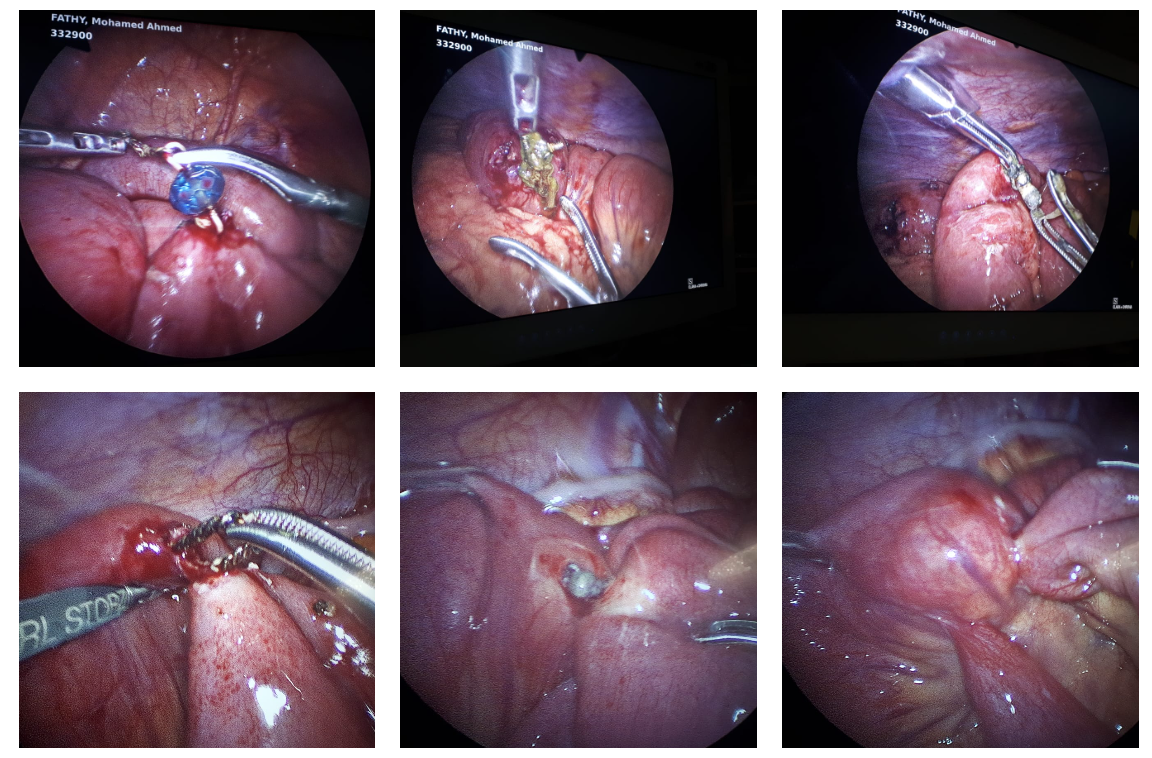 16 Pieces of Magnet and Metals Retrieved and 10 Entero-enteric Fistulae Repaired Laparoscopically
