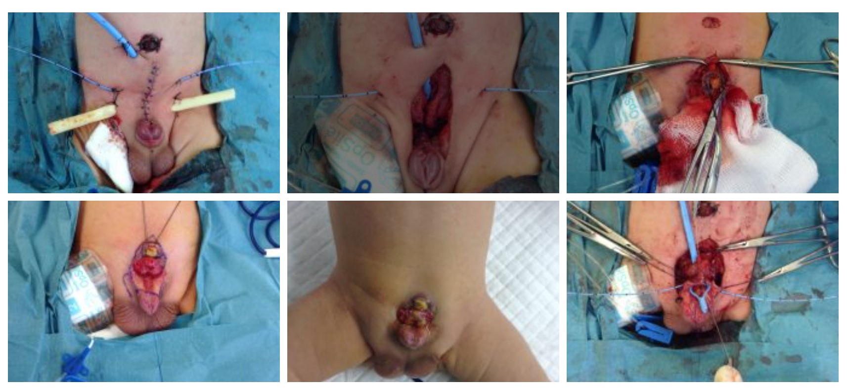 Exstrophy Bladder Repair